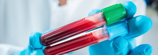 בדיקת חלבונים Protein Electrophoresis - תמונה